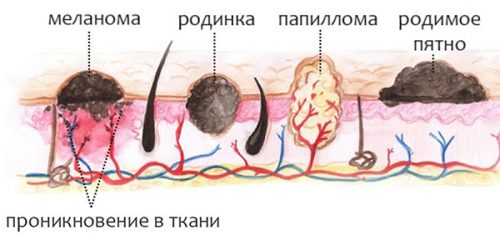 Виды новообразований