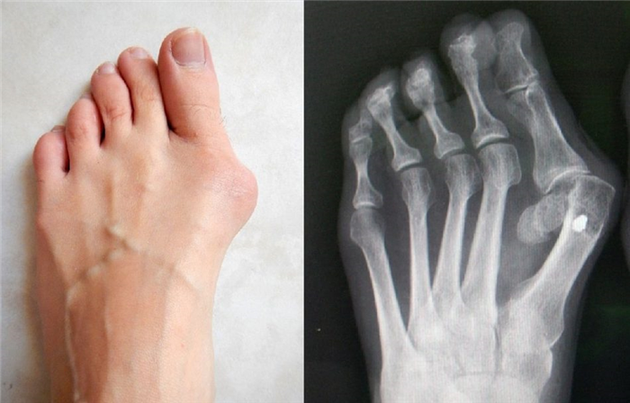 Hallux Vargus