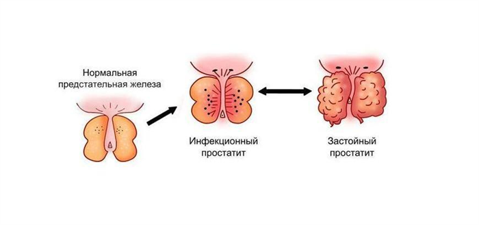 Виды простатита