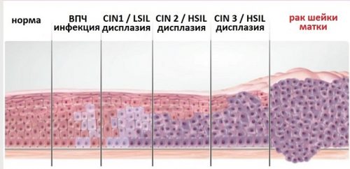 Степени дисплазии
