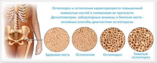Остеопороз