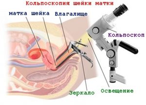 Кольпоскопия шейки матки