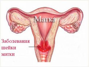 Травмирование шейки матки