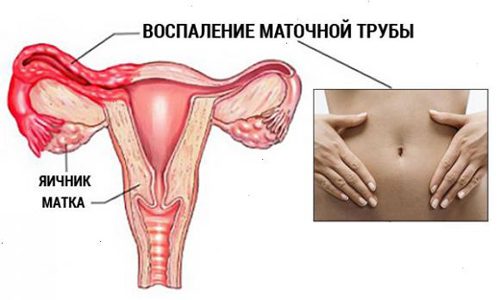 Воспаление маточной трубы