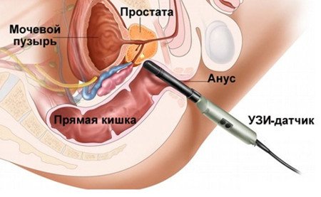 Ректальное исследование предстательной железы