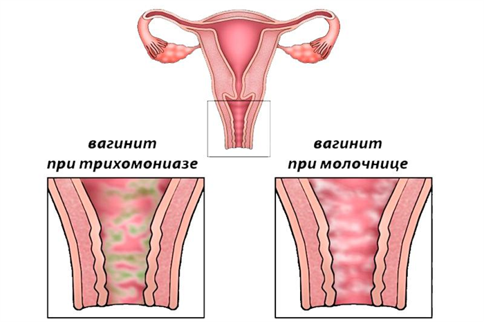 Вагинит при молочнице и трихомониазе