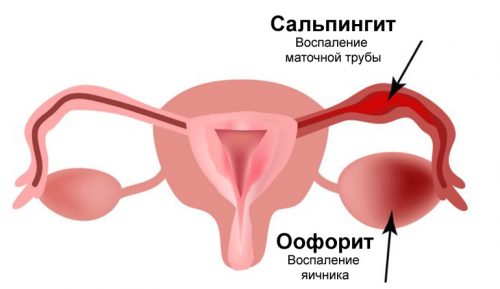 Схема сальпингоофорита