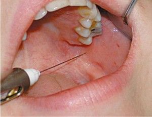 Стоимость анестезии в стоматологии