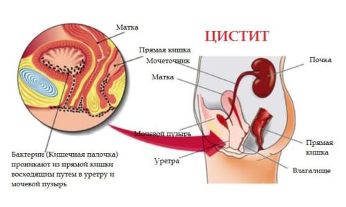 Патогенные микроорганизмы могут проникать в мочевой пузырь извне восходящим путем, двигаясь по уретре, спускаться из почек или попадать в мочевыделительный орган из других инфекционных очагов вместе с током крови и лимфы