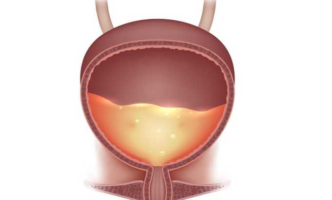 Возникновение темной урины возможно при воспалении мочевого пузыря