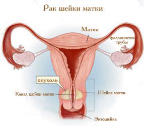 Опухоль матки