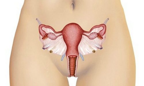 Эндометриоидная киста яичника у женщин