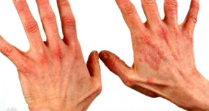 Аллергия на руках