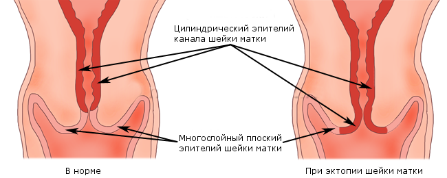 Схема эктопии