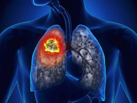 Рак легких – часто встречающийся вид онкологии