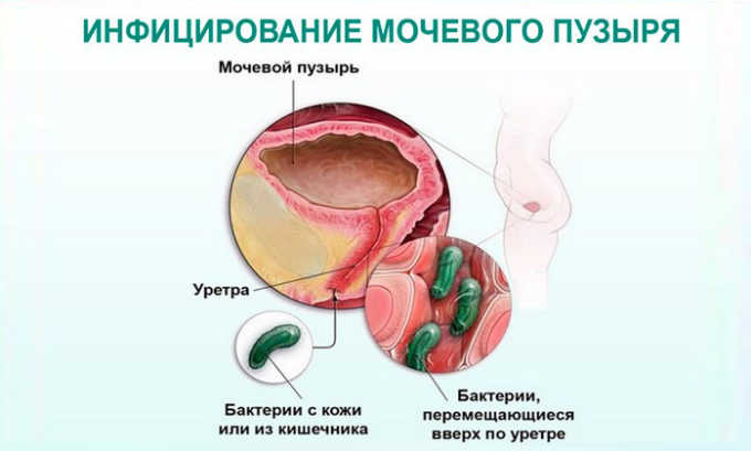 Возбудитель инфекции может проникнуть в мочевой пузырь через почки, прямую кишку, из влагалища или вместе с кровью из любого инфекционного очага в организме