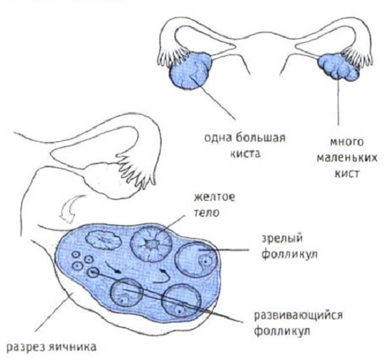 Строение яичника и кисты