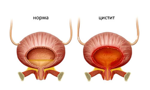 Для шеечного цистита характерна локализация воспалительного процесса в области шейки органа и длительное хроническое течение