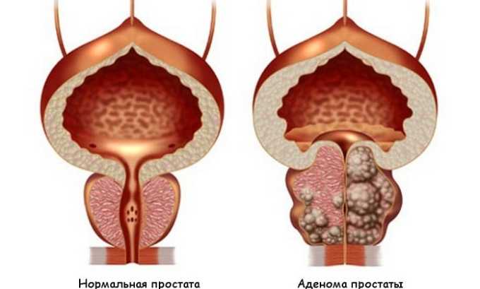 Если у мужчины кровь обнаруживается не только в урине, но и в сперме то это может свидетельствовать от том, что существуют проблемы с предстательной железой