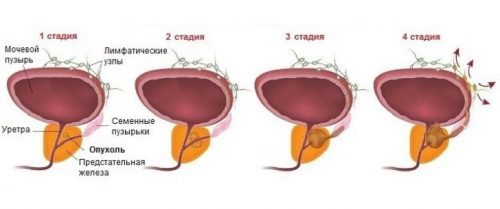 Стадии аденомы предстательной железы