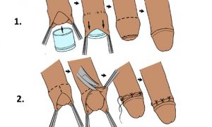Методы обрезания