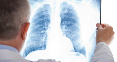 В руках пульмонолога рентгеновский снимок с признаками фиброза легких