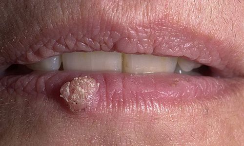Возникновение папилломы на губе