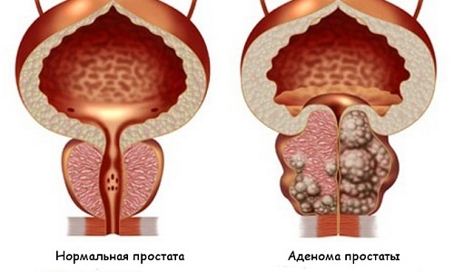 У мужчин кистозный цистит часто протекает на фоне аденомы простаты