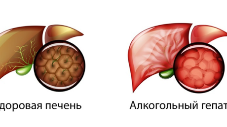 Алкогольный гепатит: признаки, виды, осложнения