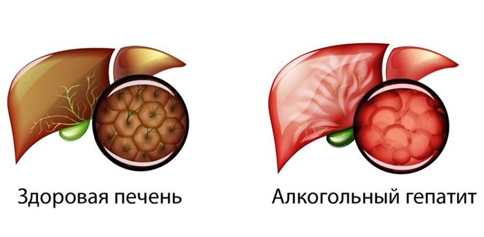 Алкогольный гепатит: признаки, виды, осложнения