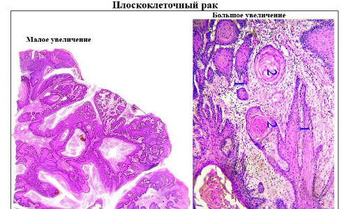 Чем опасно развитие плоскоклеточного рака шейки матки?