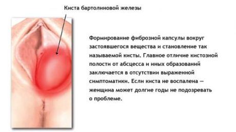 Чем опасно развитие кисты бартолиновой железы?