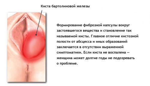 Чем опасно развитие кисты бартолиновой железы?