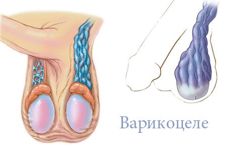 Что делать при возникновении рецидива варикоцеле?