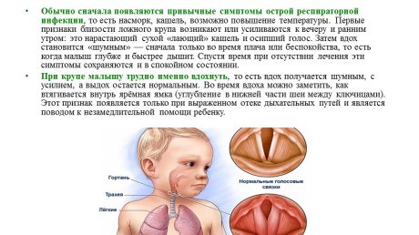 Что делать при крупе у ребенка
