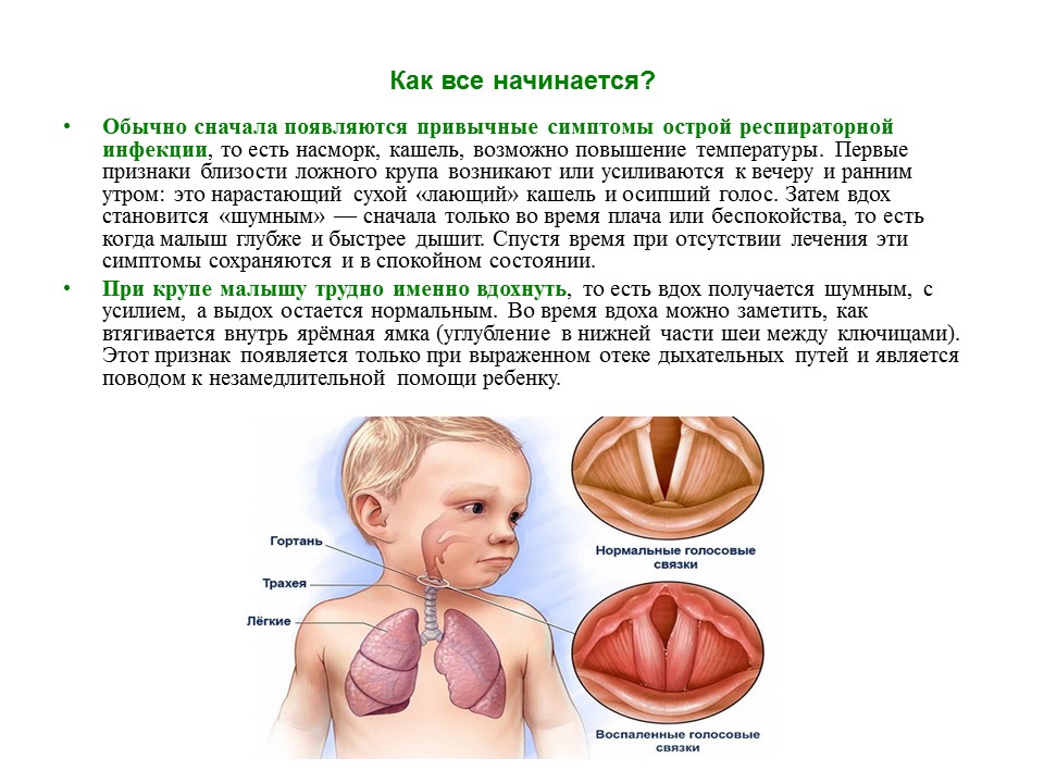 Что делать при крупе у ребенка