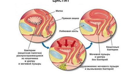 Что такое бактериальный цистит?