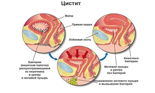 Что такое бактериальный цистит?