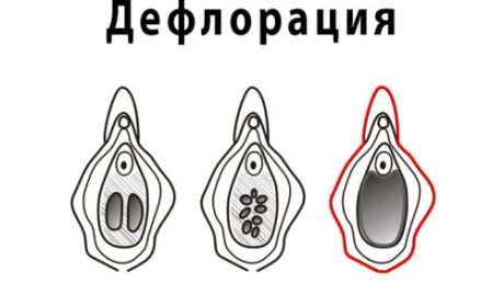 Что такое дефлорационный цистит?