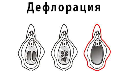 Что такое дефлорационный цистит?