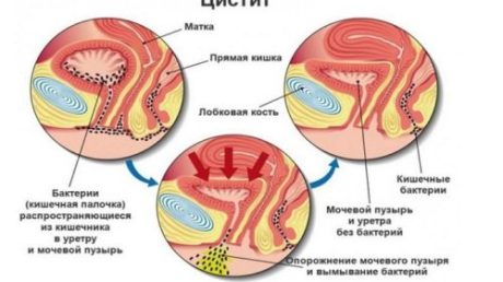 Что такое цистит, какие симптомы он вызывает и как лечится