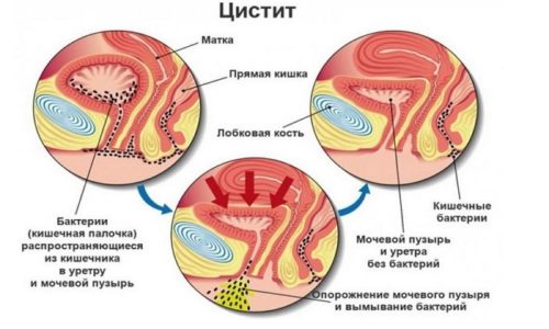 Что такое цистит, какие симптомы он вызывает и как лечится