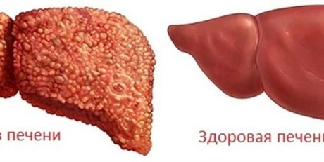 Цирроз печени: стадии, признаки, осложнения и последствия