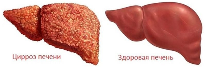 Цирроз печени: стадии, признаки, осложнения и последствия