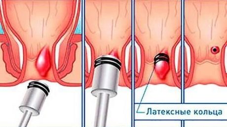 Геморрой – моя профессиональная болезнь