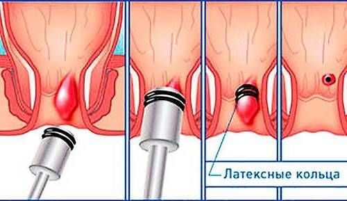 Геморрой – моя профессиональная болезнь