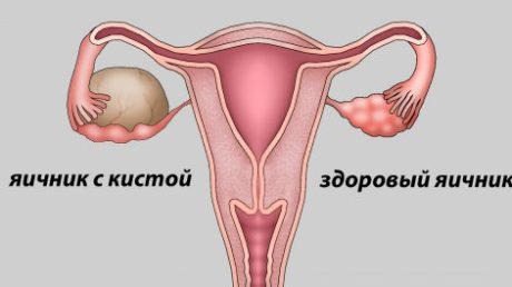 Исследование кисты правого и левого яичника на УЗИ