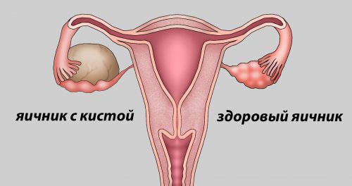 Исследование кисты правого и левого яичника на УЗИ