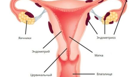 Как эндометриоз у женщин может влиять на месячные?