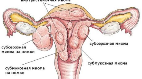 Как определить саркому матки и чем ее лечить?